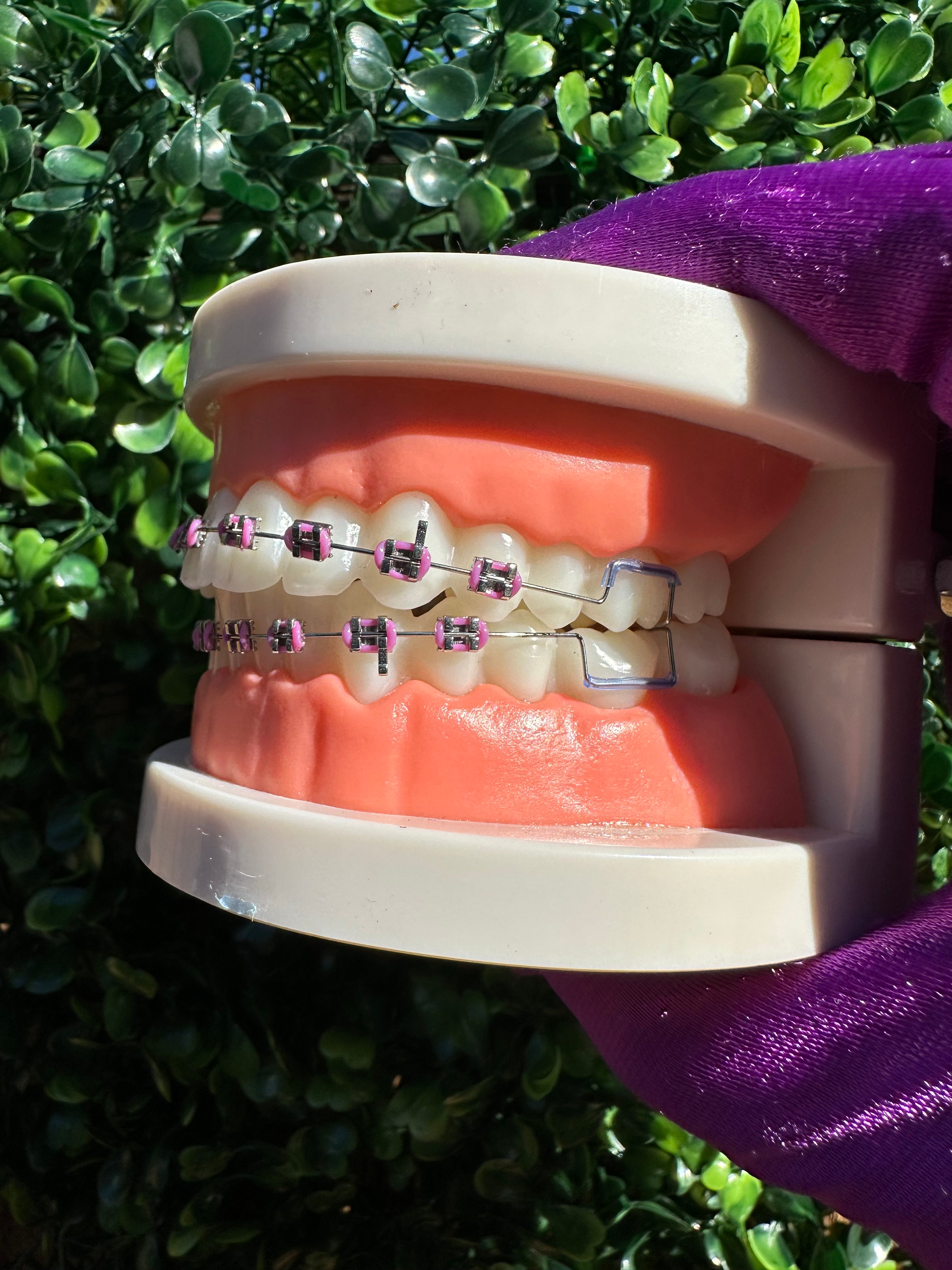 Clip-on braces