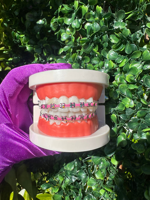 Powerchain clip-on braces